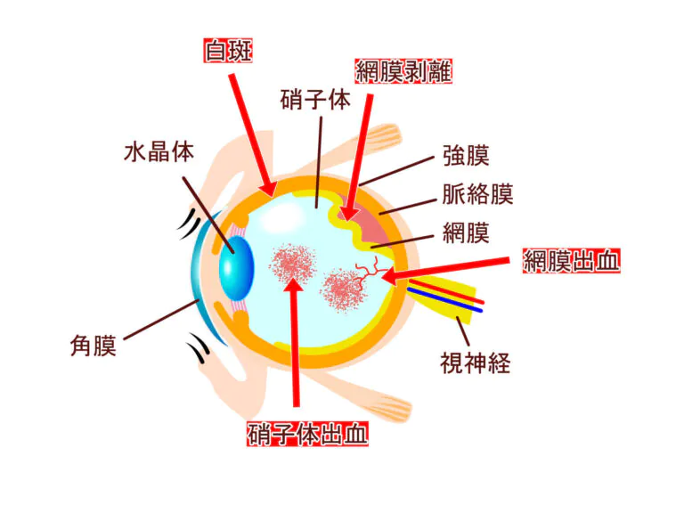 糖尿病網膜症