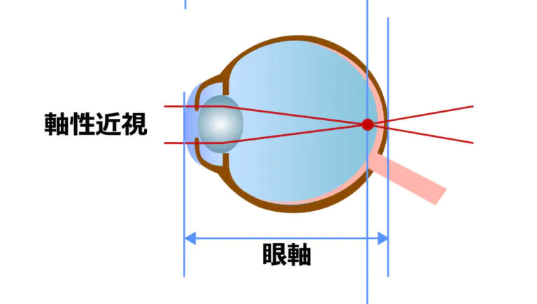 軸性近視