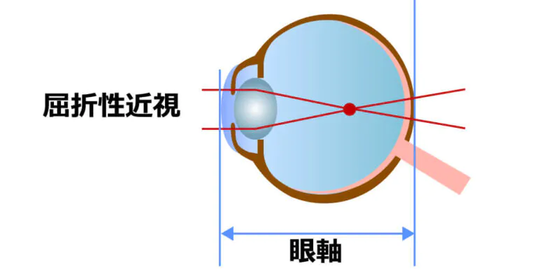 屈折性近視