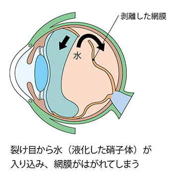 網膜剥離