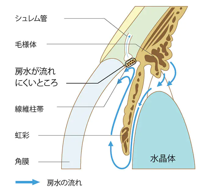 原発開放隅角緑内障