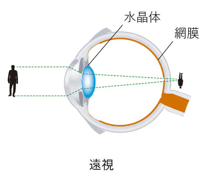 遠視とは