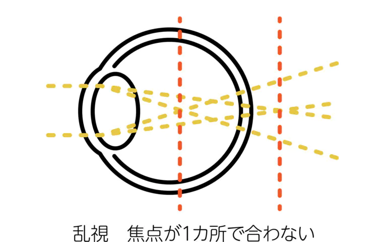 乱視とは