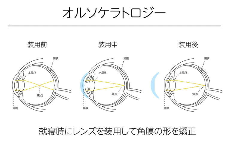 オルソケラトロジーとは